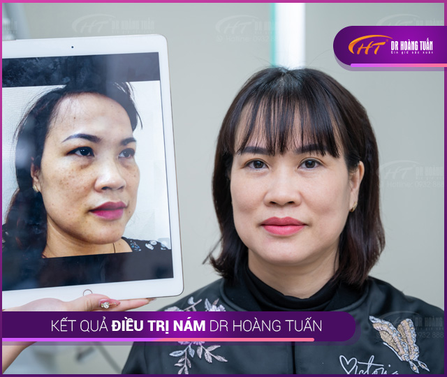 Kết quả điều trị nám tại Thẩm mỹ Hoàng Tuấn